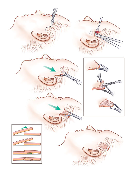 FREE Plastic Surgery: Face Lift Tape Tutorial