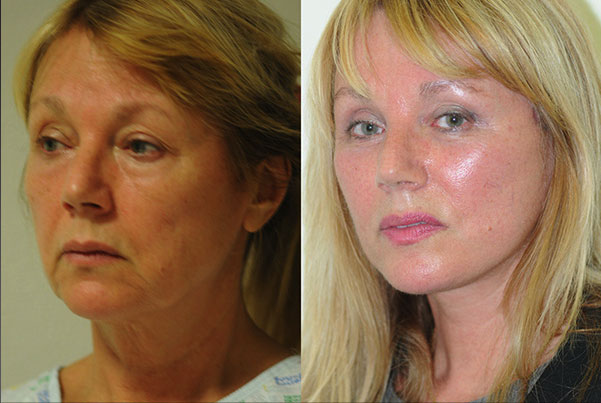 before and after blepharoplasty