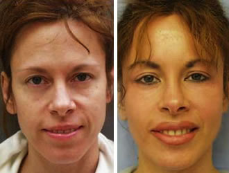 before and after lip augmentation,