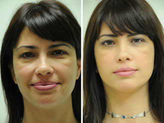 one stitch facelift before and after photo,