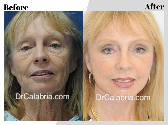 VerticalFacelift-Blog_BA_Img