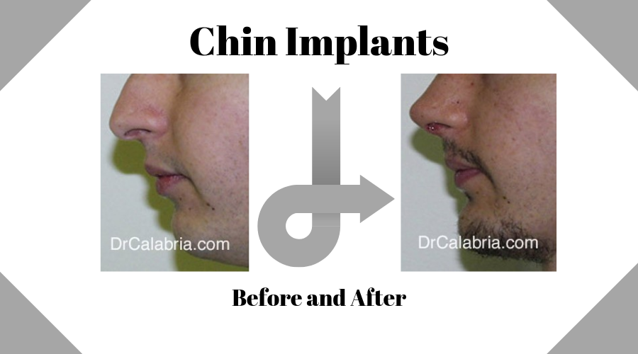 Chin Implants