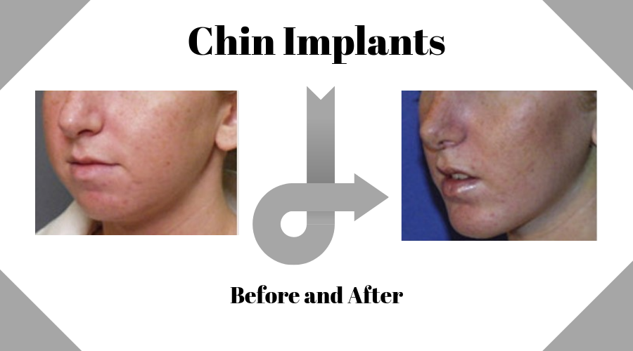 Copy of Chin Implants