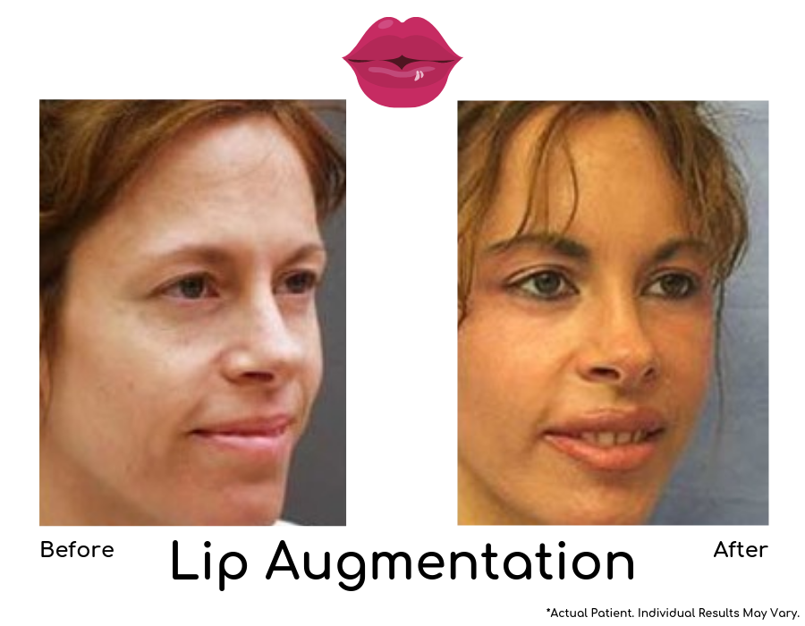 Lip Augmentation-img-blog