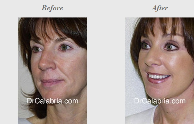 A woman before and after her rhinoplasty surgery.