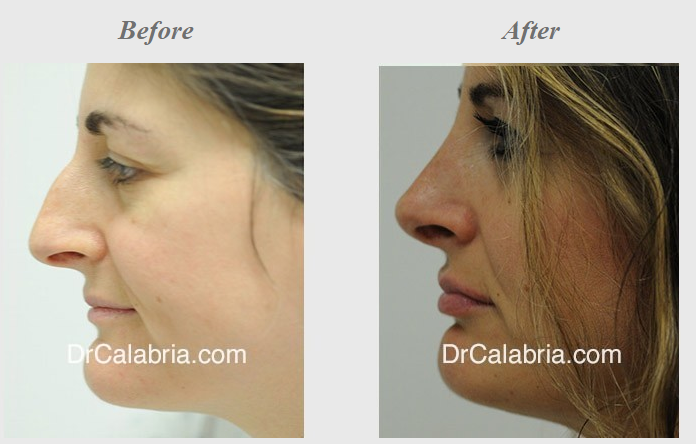 A woman before and after her rhinoplasty surgery.