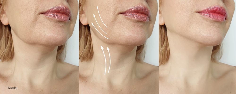 Facelift surgery provides transformative results. But are they permanent? Here's what you need to know about the facelift.