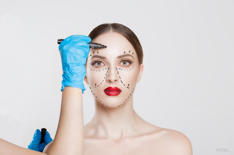 Woman with lines drawn on her bare face in preparation for a plastic surgery procedure.